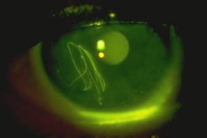 Oogletsel: Kras op het oog - cornea abrasie