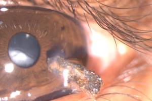 Oogletsel: Perforatie van het oog