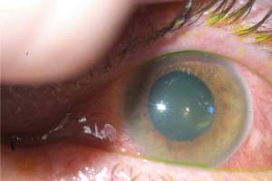 Oogletsel: chemische verbranding van het oog