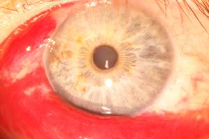 Oogletsel: oogbloedingen - conjunctivale bloedingen